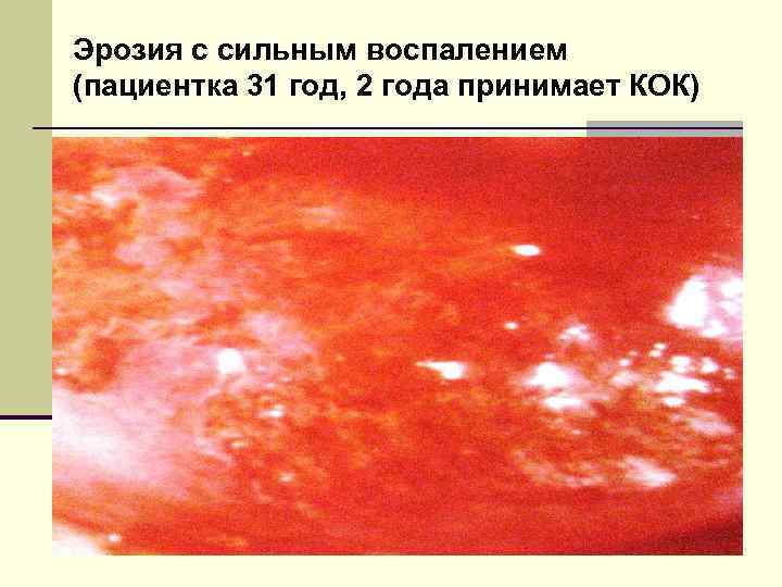 Эрозия с сильным воспалением (пациентка 31 год, 2 года принимает КОК) 