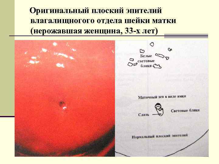 Оригинальный плоский эпителий влагалищногого отдела шейки матки (нерожавшая женщина, 33 -х лет) 