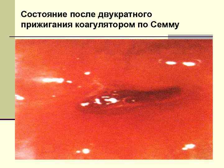 Состояние после двукратного прижигания коагулятором по Семму 