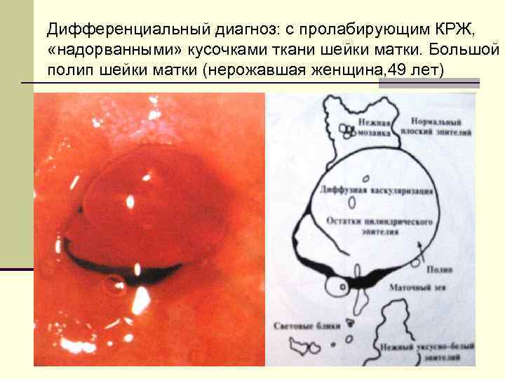 Дифференциальный диагноз: с пролабирующим КРЖ, «надорванными» кусочками ткани шейки матки. Большой полип шейки матки