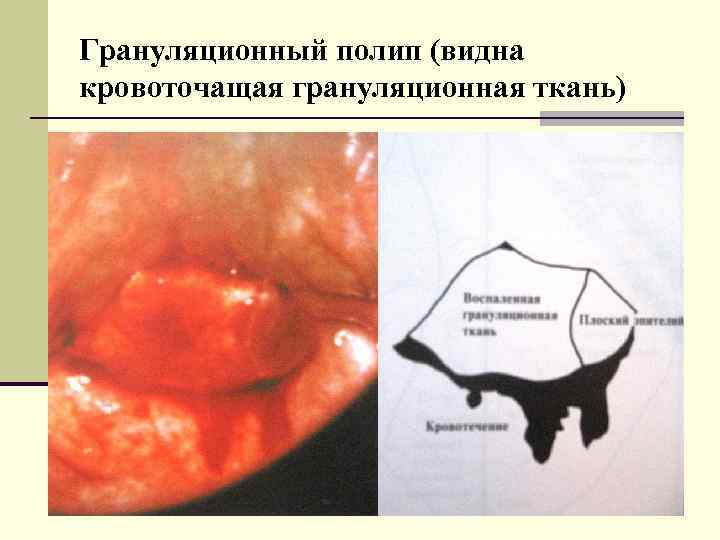 Грануляционный полип (видна кровоточащая грануляционная ткань) 