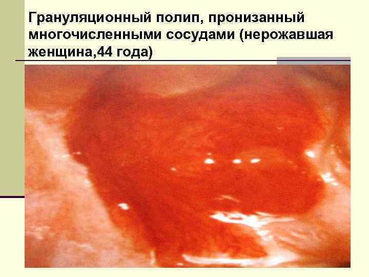 Грануляционный полип, пронизанный многочисленными сосудами (нерожавшая женщина, 44 года) 