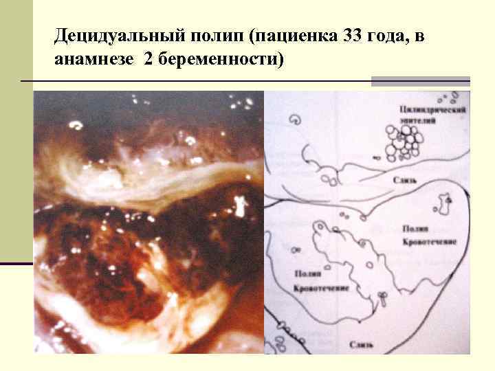 Децидуальный полип (пациенка 33 года, в анамнезе 2 беременности) 