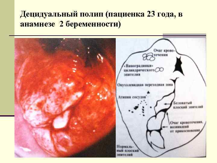 Децидуальный полип (пациенка 23 года, в анамнезе 2 беременности) 
