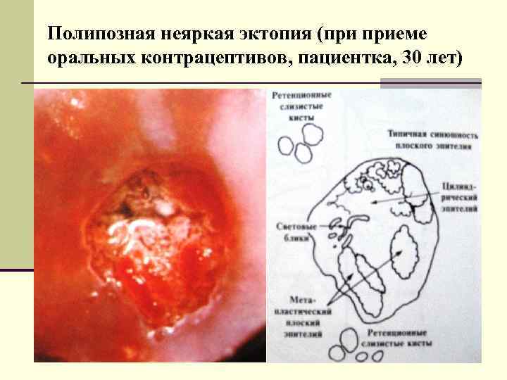 Полипозная неяркая эктопия (при приеме оральных контрацептивов, пациентка, 30 лет) 