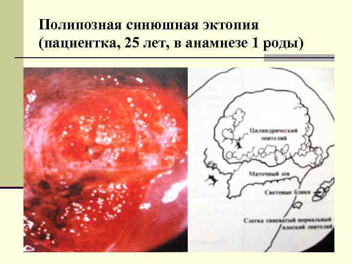 Полипозная синюшная эктопия (пациентка, 25 лет, в анамнезе 1 роды) 