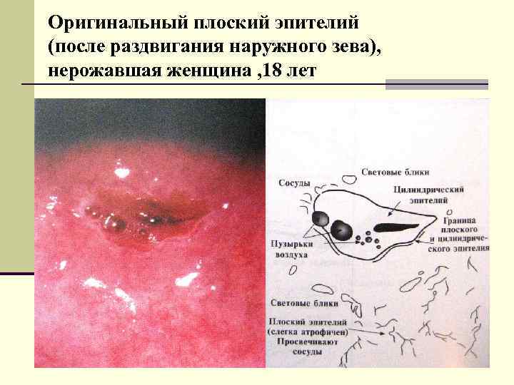 Оригинальный плоский эпителий (после раздвигания наружного зева), нерожавшая женщина , 18 лет 