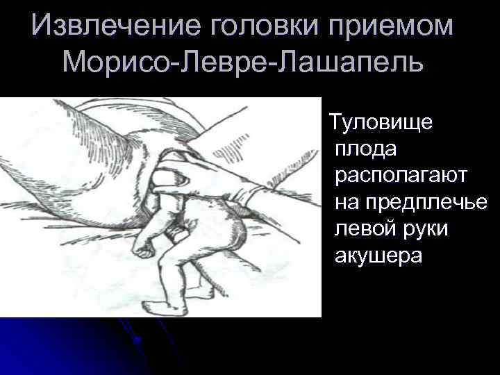 Извлечение головки приемом Морисо-Левре-Лашапель Туловище плода располагают на предплечье левой руки акушера 