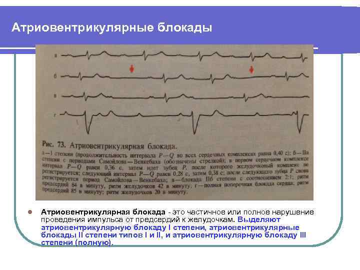 Что значит нарушение проводимости. Блокада атриовентрикулярной проводимости. Нарушения блокады атриовентрикулярная. Нарушение сердечного ритма атриовентрикулярная блокада. Нарушение атриовентрикулярной проводимости.