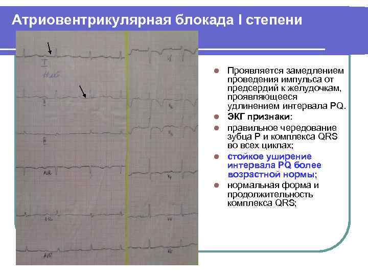 Атриовентрикулярная блокада I степени l l l Проявляется замедлением проведения импульса от предсердий к