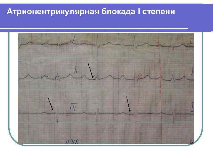 Атриовентрикулярная блокада I степени 