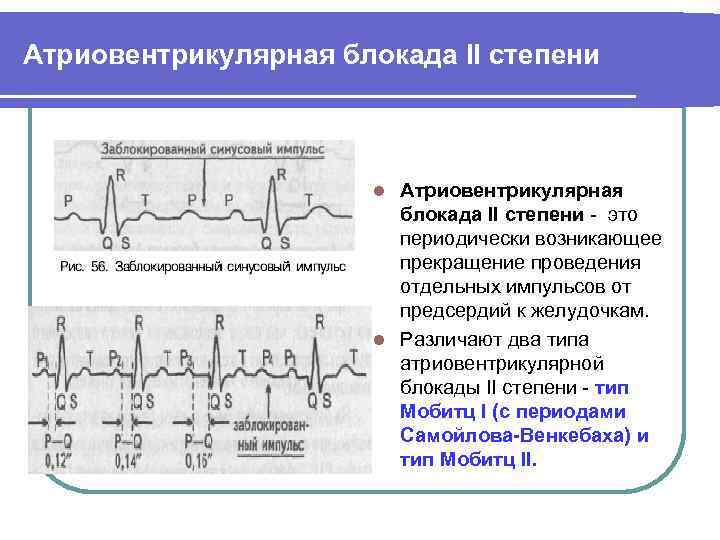 Атриовентрикулярная блокада признаки. Атриовентрикулярная блокада на ЭКГ. Степени атриовентрикулярной блокады. Блокада атриовентрикулярного узла. Атриовентрикулярная блокада 1 степени причины.