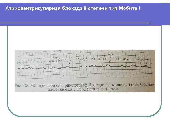 Атриовентрикулярная блокада II степени тип Мобитц I 