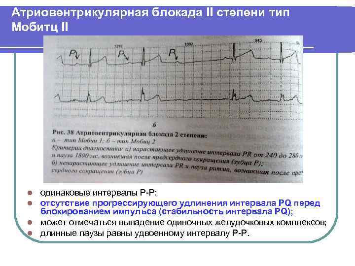 Выпадение комплекса. АВ блокада 2 степени Мобитц 1 критерии. АВ блокада 2 степени Мобитц 1 ритм. АВ-блокада 2 степени Мобитц 2 критерии. Блокада типа Мобитц 2 характеризуется.