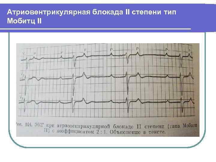 Атриовентрикулярная блокада II степени тип Мобитц II 