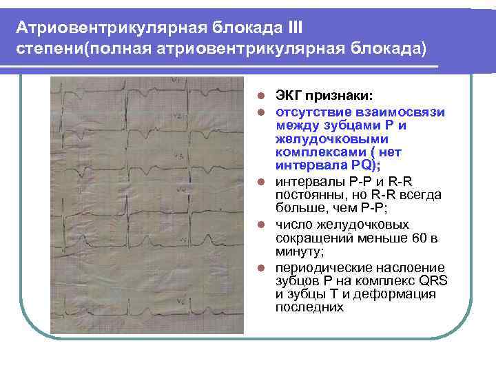 Атриовентрикулярная блокада III степени(полная атриовентрикулярная блокада) ЭКГ признаки: отсутствие взаимосвязи между зубцами Р и