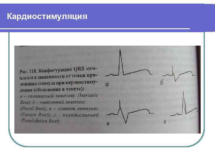 Кардиостимуляция 