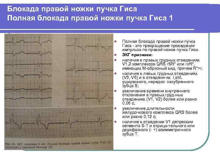 Блокада правой ножки пучка Гиса Полная блокада правой ножки пучка Гиса 1 l l