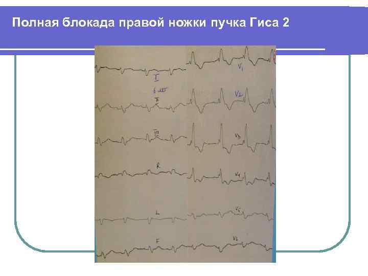 Полная блокада правой ножки пучка