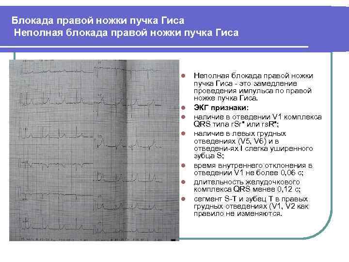 Блокада правой ножки пучка Гиса Неполная блокада правой ножки пучка Гиса l l l