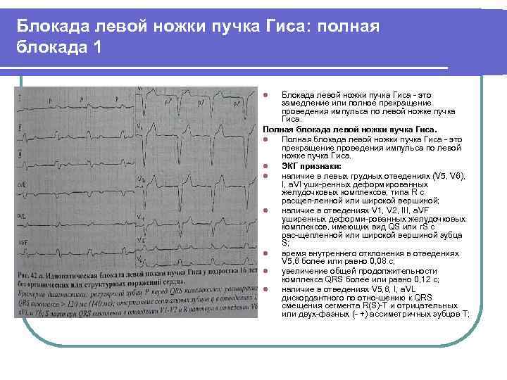Блокада левой ножки пучка Гиса: полная блокада 1 Блокада левой ножки пучка Гиса это