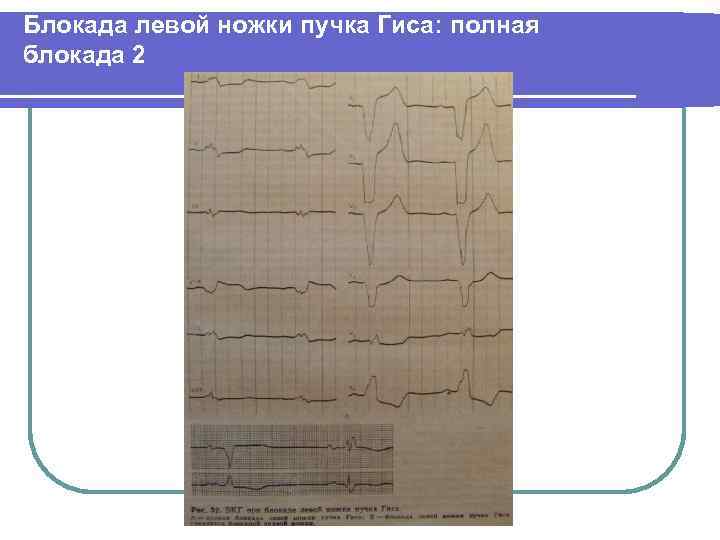 Блокада левой ножки пучка Гиса: полная блокада 2 