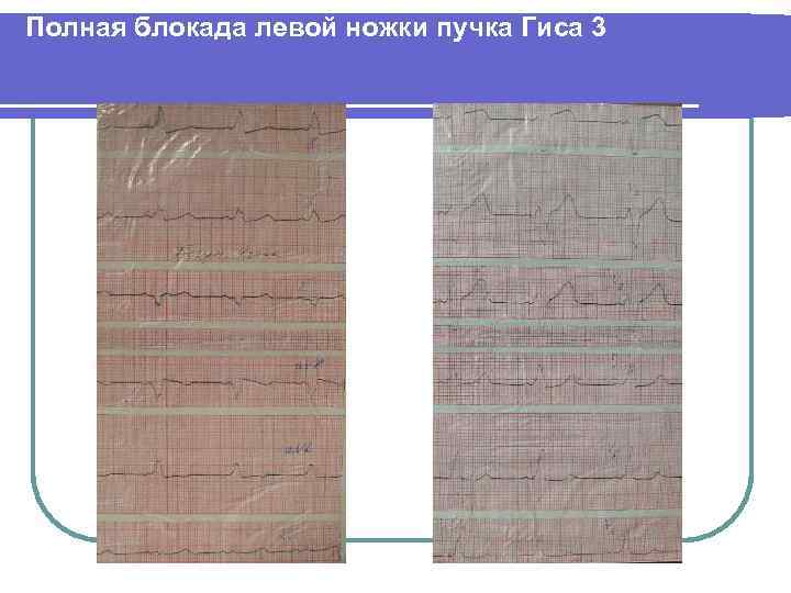 Полная блокада левой ножки пучка Гиса 3 