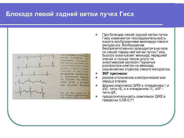 Блокада левой задней ветви пучка Гиса l l l При блокаде левой задней ветви
