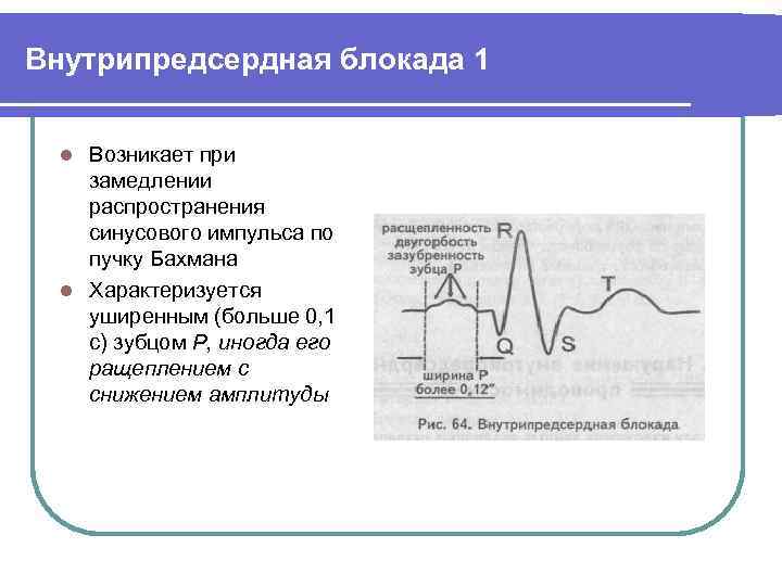 Замедление проводимости. Внутрипредсердная блокада 1 степени на ЭКГ что это такое. ЭКГ при блокаде пучка Бахмана. Внутрипредсердная блокада 3 степени ЭКГ. Нарушение внутрипредсердной проводимости на ЭКГ.