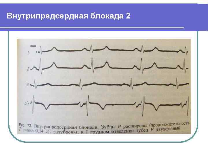 Внутрипредсердная проводимость