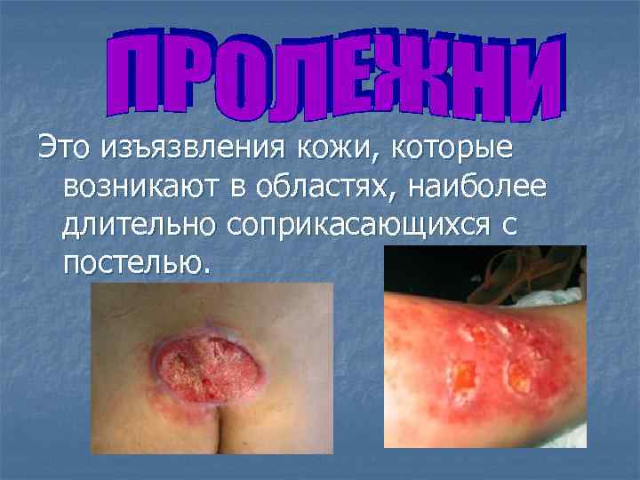 Это изъязвления кожи, которые возникают в областях, наиболее длительно соприкасающихся с постелью. 