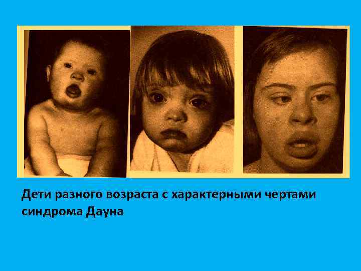Дети разного возраста с характерными чертами синдрома Дауна 