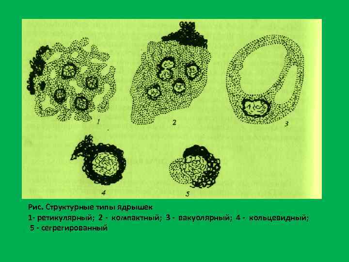 Рис. Структурные типы ядрышек 1 ретикулярный; 2 компактный; 3 вакуолярный; 4 кольцевидный; 5 сегрегированный