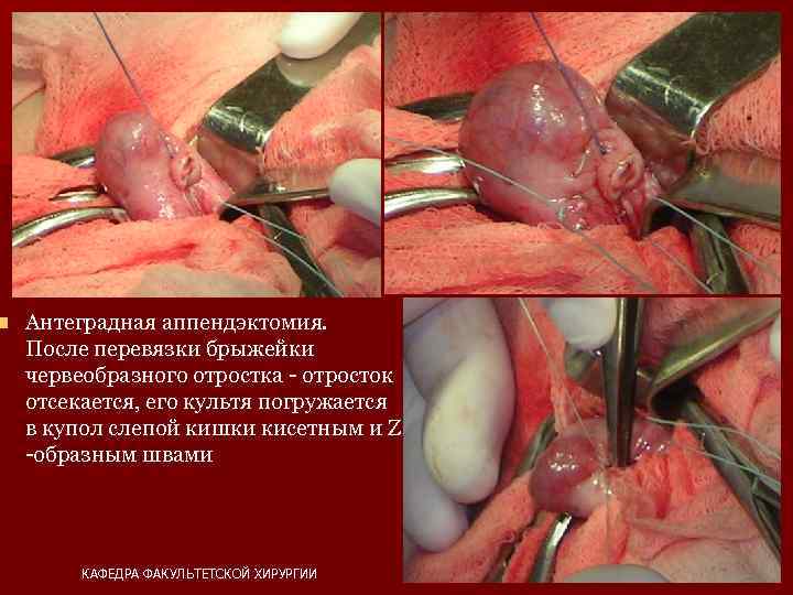 n Антеградная аппендэктомия. После перевязки брыжейки червеобразного отростка - отросток отсекается, его культя погружается