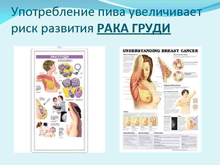 Употребление пива увеличивает риск развития РАКА ГРУДИ 