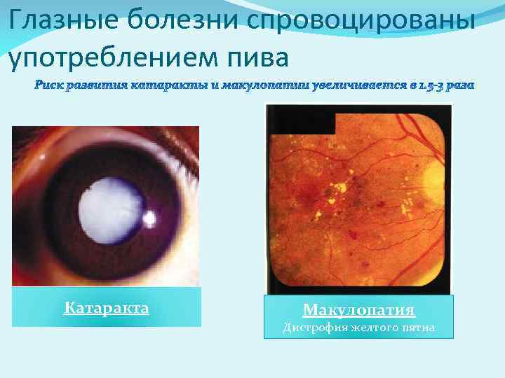 Глазные болезни спровоцированы употреблением пива Катаракта Макулопатия Дистрофия желтого пятна 