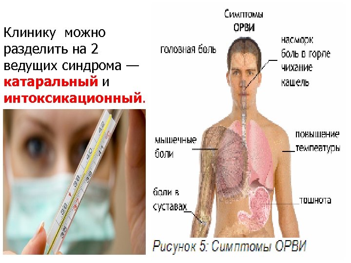 Клинику можно разделить на 2 ведущих синдрома — катаральный и интоксикационный. 