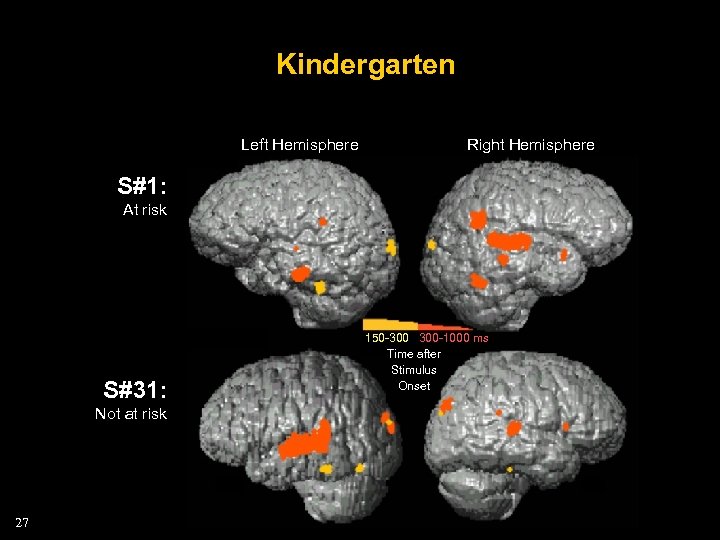 Kindergarten Left Hemisphere Right Hemisphere S#1: At risk S#31: Not at risk 27 150
