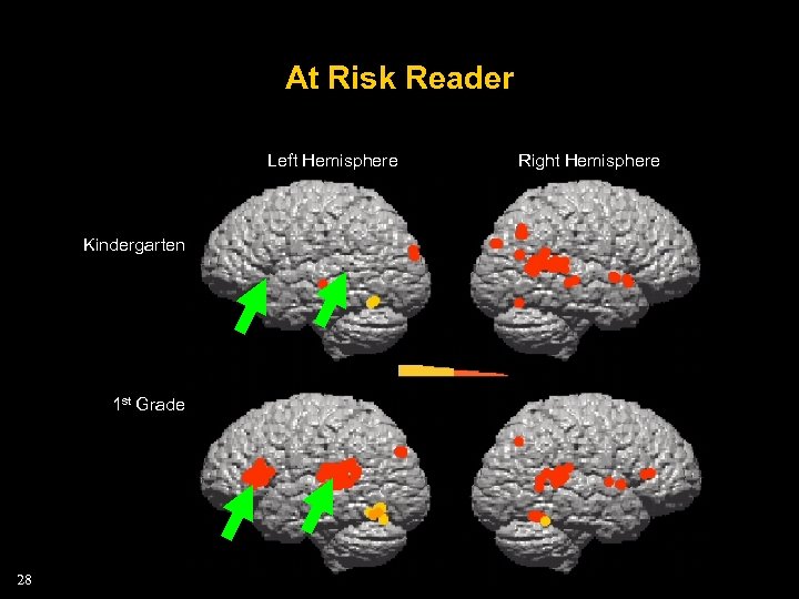 At Risk Reader Left Hemisphere Kindergarten 1 st Grade 28 Right Hemisphere 