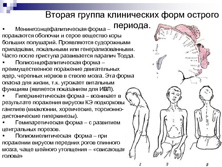 Вторая группа клинических форм острого Менингоэнцефалитическая форма – периода. § поражаются оболочки и серое