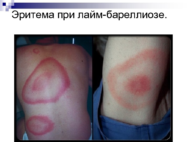 Эритема при лайм-бареллиозе. 