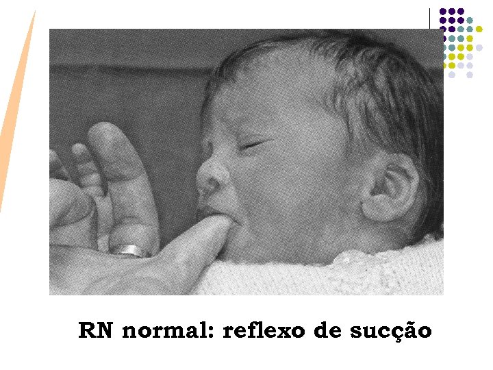 RN normal: reflexo de sucção 