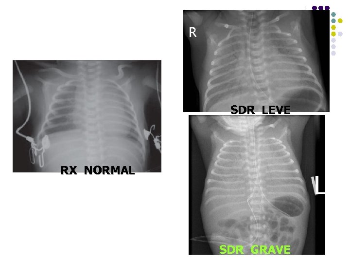 SDR LEVE RX NORMAL SDR GRAVE 