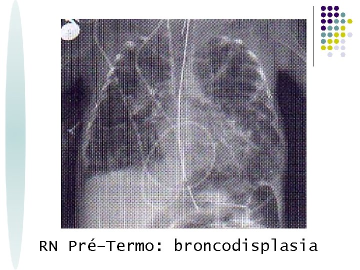 RN Pré–Termo: broncodisplasia 