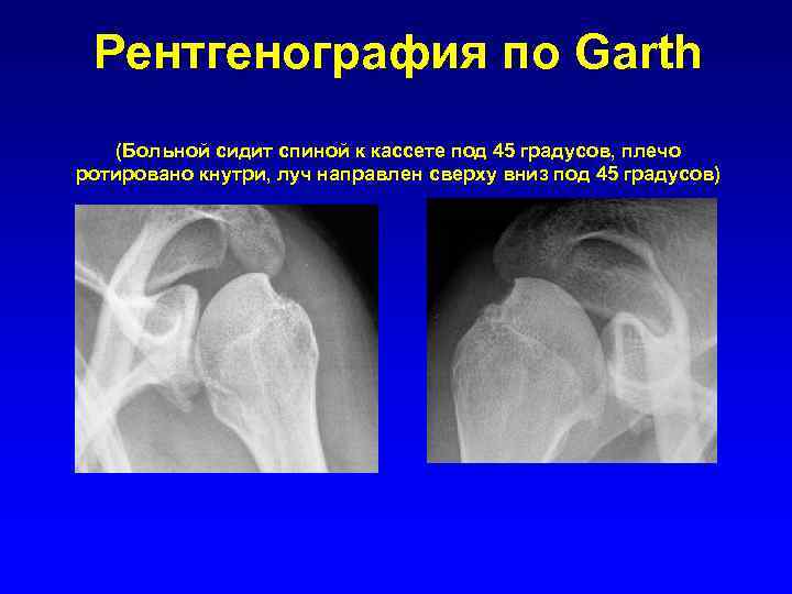 Рентгенография по Garth (Больной сидит спиной к кассете под 45 градусов, плечо ротировано кнутри,