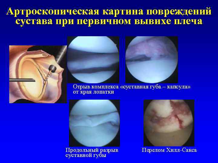 Артроскопическая картина повреждений сустава при первичном вывихе плеча Отрыв комплекса «суставная губа – капсула»