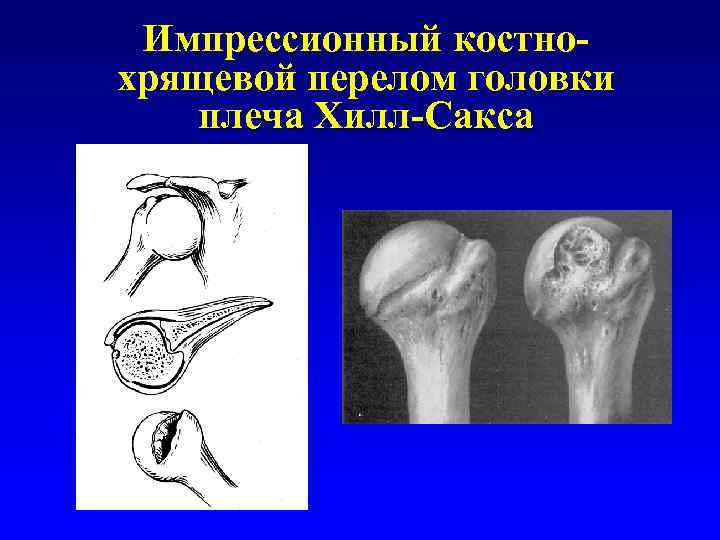 Импрессионный костнохрящевой перелом головки плеча Хилл-Сакса 
