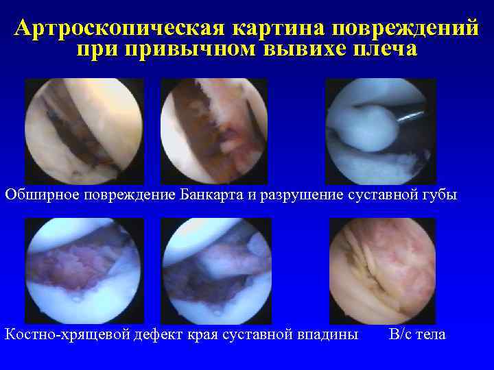 Артроскопическая картина повреждений привычном вывихе плеча Обширное повреждение Банкарта и разрушение суставной губы Костно-хрящевой