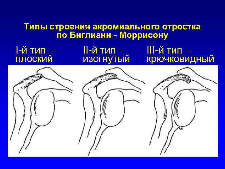 Типы строения акромиального отростка по Биглиани - Mоррисону I-й тип – плоский II-й тип