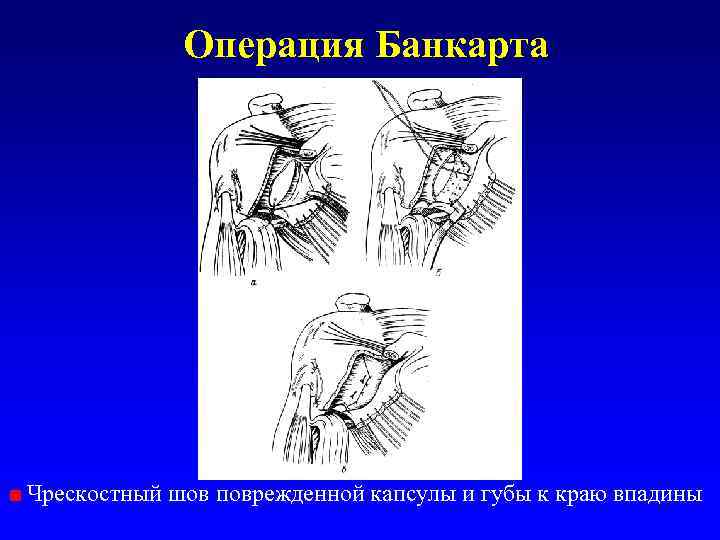 Операция Банкарта Чрескостный шов поврежденной капсулы и губы к краю впадины 